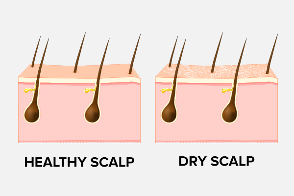 dry scalp causes