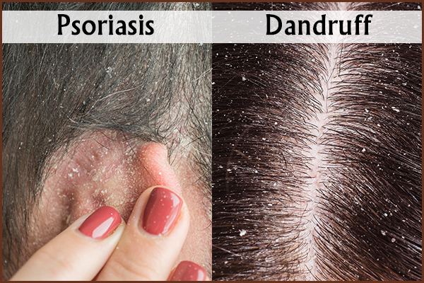 psoriasis versus dandruff: what's the difference?