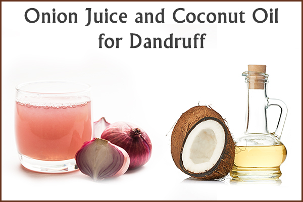 use onion juice and coconut oil for dandruff control