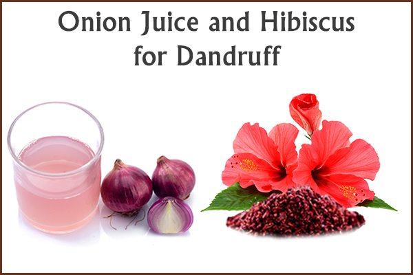 use onion juice and hibiscus for dandruff control